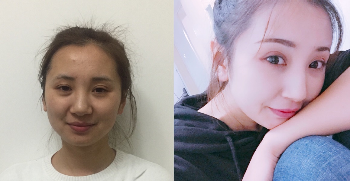 貴陽藝齡醫(yī)療美容門診部醫(yī)生李章做隆鼻手術怎么樣？附案例效果對比圖