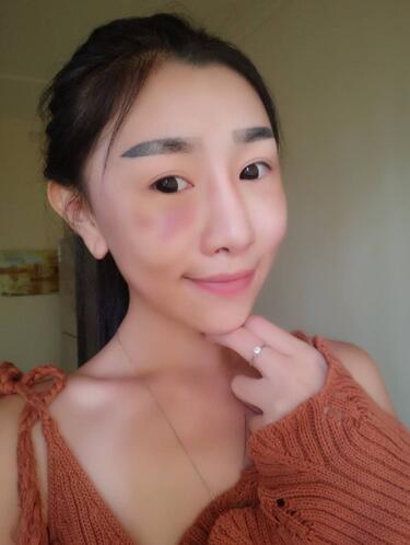 貴陽(yáng)泰康樂(lè)醫(yī)院整形美容科醫(yī)生陳璐做自體脂肪全臉填充效果怎么樣？