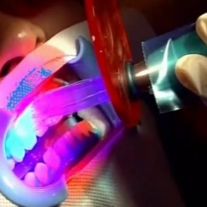 北京美年口腔醫(yī)院醫(yī)生劉海濤做牙齒冷光美白怎么樣？附案例效果對(duì)比圖