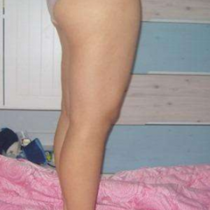 長沙真愛整形美容醫(yī)院醫(yī)生陳詠玲做大腿吸脂效果怎么樣？