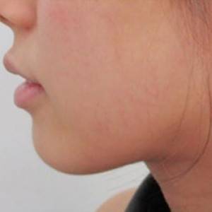 蚌埠韓美美萊整形醫(yī)院醫(yī)生張濤做玻尿酸墊下巴怎么樣？來看案例效果圖