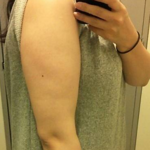 長(zhǎng)沙柒和醫(yī)療整形醫(yī)生鐘滔做手臂吸脂怎么樣？附案例效果對(duì)比圖