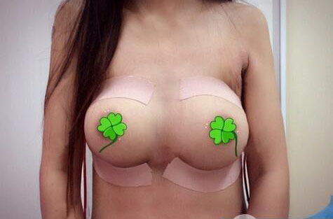 海南伊佳醫(yī)療美容醫(yī)院醫(yī)生涂陽君做假體隆胸怎么樣？附案例效果對比圖