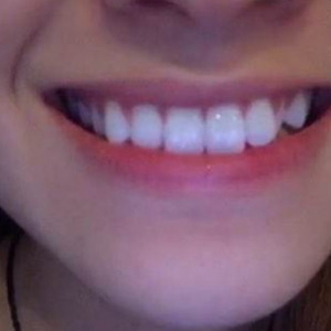 北京美年口腔醫(yī)院醫(yī)生劉海濤做牙齒冷光美白怎么樣？附案例效果對(duì)比圖