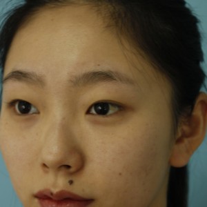 鄭州安格潤整形醫(yī)生楊曉紅做雙眼皮手術(shù)怎么樣？附案例效果圖