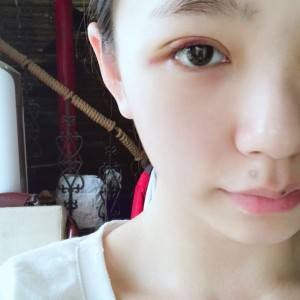 鄭州安格潤整形醫(yī)生楊曉紅做雙眼皮手術(shù)怎么樣？附案例效果圖