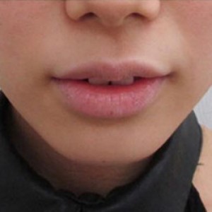 蚌埠韓美美萊整形醫(yī)院醫(yī)生張濤做玻尿酸墊下巴怎么樣？來看案例效果圖