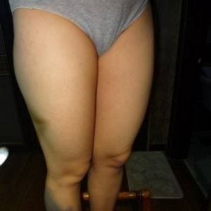 長沙真愛整形美容醫(yī)院醫(yī)生陳詠玲做大腿吸脂效果怎么樣？