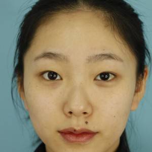 鄭州安格潤整形醫(yī)生楊曉紅做雙眼皮手術(shù)怎么樣？附案例效果圖