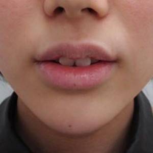 蚌埠韓美美萊整形醫(yī)院醫(yī)生張濤做玻尿酸墊下巴怎么樣？來看案例效果圖