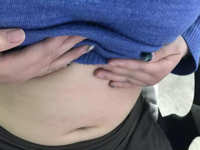 廣州尚美善造美容醫(yī)院醫(yī)生邵方做水動(dòng)力吸脂怎么樣？附案例效果圖