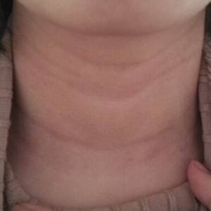 昭通愛麗諾整形醫(yī)生陳志江做嗨體去頸紋怎么樣？附案例效果圖