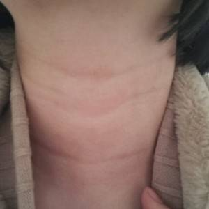 昭通愛麗諾整形醫(yī)生陳志江做嗨體去頸紋怎么樣？附案例效果圖