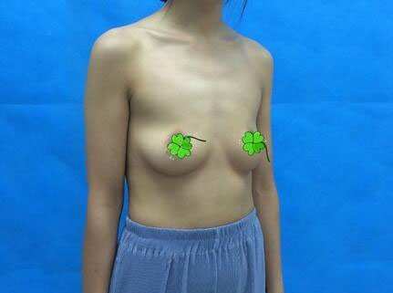 海南伊佳醫(yī)療美容醫(yī)院醫(yī)生涂陽君做假體隆胸怎么樣？附案例效果對比圖