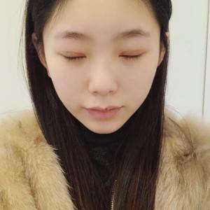 鄭州安格潤整形醫(yī)生楊曉紅做雙眼皮手術(shù)怎么樣？附案例效果圖