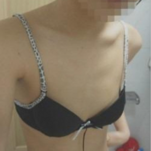 三亞圣迪亞整形美容醫(yī)院醫(yī)生韓超做假體隆胸怎么樣？附案例效果對比圖