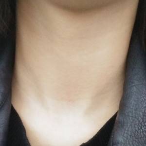 昭通愛麗諾整形醫(yī)生陳志江做嗨體去頸紋怎么樣？附案例效果圖