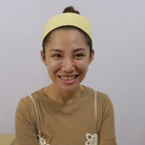 保定東陽(yáng)口腔醫(yī)院醫(yī)生白小青做牙齒冷光美白怎么樣？附案例效果對(duì)比圖