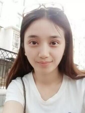 長(zhǎng)治松禾醫(yī)療美容診所醫(yī)生馬俊峰做韓式微創(chuàng)定點(diǎn)雙眼皮效果怎么樣？附案例