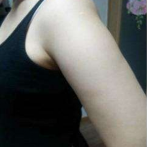 長(zhǎng)沙柒和醫(yī)療整形醫(yī)生鐘滔做手臂吸脂怎么樣？附案例效果對(duì)比圖