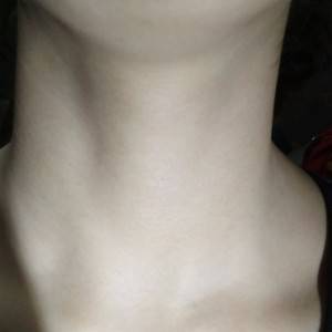 昭通愛麗諾整形醫(yī)生陳志江做嗨體去頸紋怎么樣？附案例效果圖