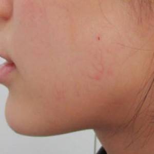 蚌埠韓美美萊整形醫(yī)院醫(yī)生張濤做玻尿酸墊下巴怎么樣？來看案例效果圖