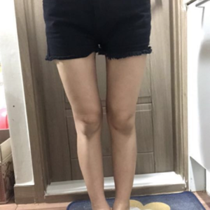 貴陽華美整形美容醫(yī)院醫(yī)生田永華做大腿吸脂效果怎么樣？附大腿吸脂案例前后對比圖