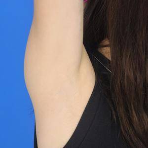 重慶中成整形美容醫(yī)院醫(yī)生田忠成激光脫腋毛效果怎么樣？附案例效果圖