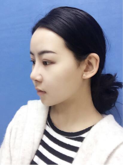 上海時光整形外科醫(yī)院醫(yī)生李靜林做假體隆鼻和反頜手術(shù)怎么樣？