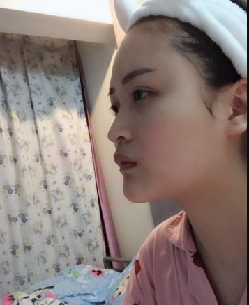 北京伊美爾美容愛康醫(yī)院醫(yī)生柳成做鼻綜合整形怎么樣？附案例效果圖