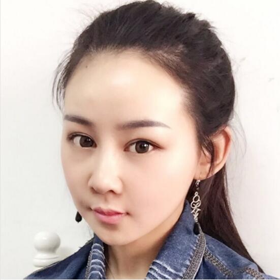 上海時光整形外科醫(yī)院醫(yī)生李靜林做假體隆鼻和反頜手術(shù)怎么樣？