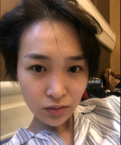 武漢米蘭醫(yī)療美容醫(yī)生柳再億做眼綜合+鼻綜合整形怎么樣？附真實(shí)案例對(duì)比圖