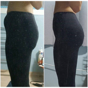 貴陽華美整形美容醫(yī)院醫(yī)生田永華做大腿吸脂效果怎么樣？附大腿吸脂案例前后對比圖