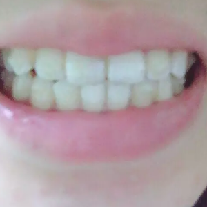 淄博口腔醫(yī)院醫(yī)生牟象鑫做超聲波洗牙怎么樣？附案例效果對比圖