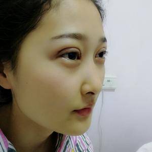 周口垣夢醫(yī)療整形醫(yī)生王濤做切開雙眼皮怎么樣？附切開雙眼皮案例效果對比圖