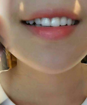 淄博口腔醫(yī)院醫(yī)生牟象鑫做超聲波洗牙怎么樣？附案例效果對比圖