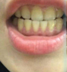 淄博口腔醫(yī)院醫(yī)生牟象鑫做超聲波洗牙怎么樣？附案例效果對比圖