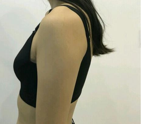 武漢伽美醫(yī)療美容醫(yī)院醫(yī)生朱富初做自體脂肪隆胸怎么樣？看案例