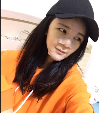 上海時(shí)光整形外科醫(yī)院醫(yī)生何晉龍做假體隆胸怎么樣？附案例效果對比圖