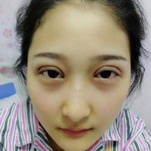 周口垣夢醫(yī)療整形醫(yī)生王濤做切開雙眼皮怎么樣？附切開雙眼皮案例效果對比圖