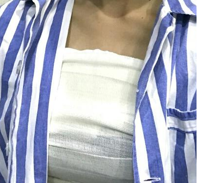 武漢伽美醫(yī)療美容醫(yī)院醫(yī)生朱富初做自體脂肪隆胸怎么樣？看案例