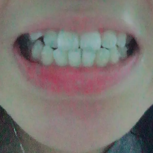 淄博口腔醫(yī)院醫(yī)生牟象鑫做超聲波洗牙怎么樣？附案例效果對比圖