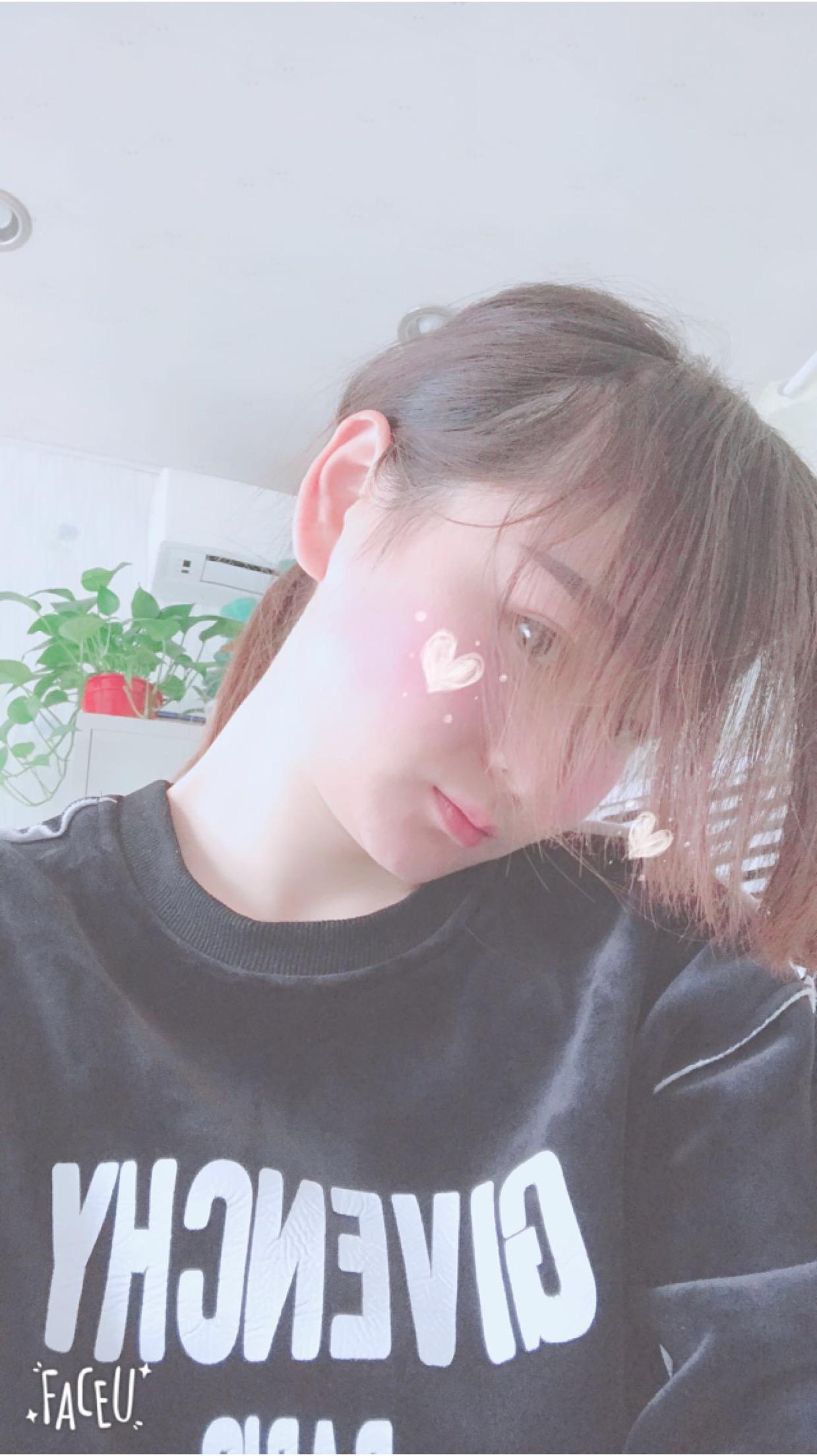 北京彤美美容整形醫(yī)院醫(yī)生楊曉惠做顴骨內(nèi)推+面部吸脂手術(shù)效果怎么樣？附案例