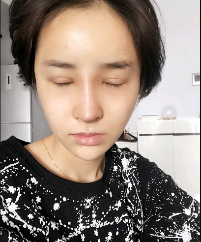 武漢米蘭醫(yī)療美容醫(yī)生柳再億做眼綜合+鼻綜合整形怎么樣？附真實(shí)案例對(duì)比圖