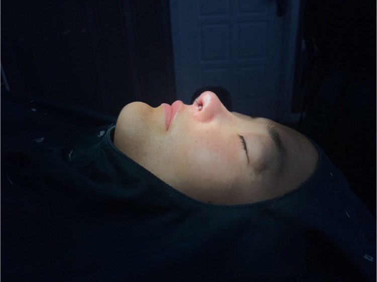 北京集美名媛醫(yī)療整形醫(yī)生陳瀅雯做自體耳軟骨隆鼻怎么樣？附案例效果圖