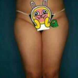 貴陽華美整形美容醫(yī)院醫(yī)生田永華做大腿吸脂效果怎么樣？附大腿吸脂案例前后對比圖