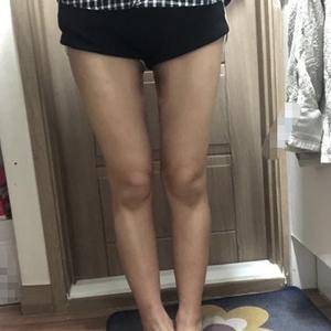 貴陽華美整形美容醫(yī)院醫(yī)生田永華做大腿吸脂效果怎么樣？附大腿吸脂案例前后對比圖