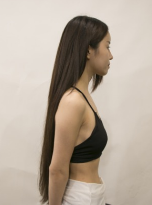 吉林現(xiàn)代整形美容醫(yī)院做假體隆胸效果怎么樣？附醫(yī)院案例效果對(duì)比圖