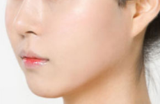 福州麥瑞整形醫(yī)院面部填充