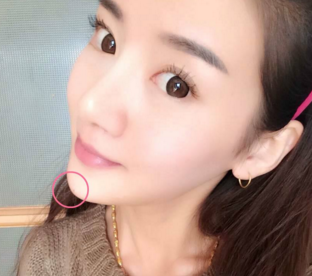 洛陽(yáng)愛(ài)尚醫(yī)療美容門診部假體墊下巴